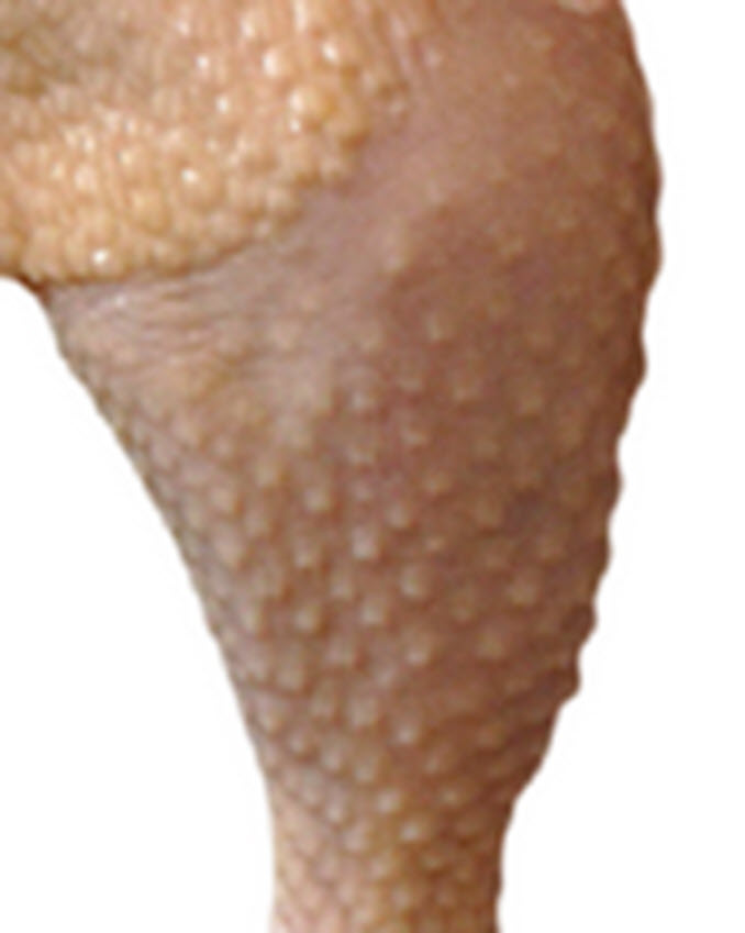 I Have Chicken Skin On My Legs Help Me 