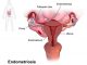 endometriosis natural treatment